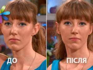 Як виправити вуха без операції