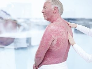 Насколько вы склонны к заболеванию псориазом? Тест