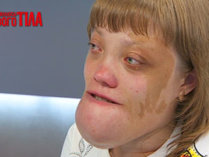 Рідкісна хвороба – синдром Олбрайта. Дивіться 11 лютого!