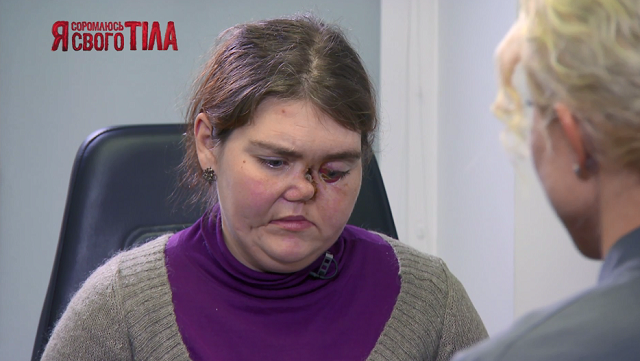 «Я соромлюсь свого тіла»-7 випуск 6: На проєкт звернувся хлопець, у якого з очей тече гній ясст