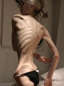 1324977285_bolezn-anorexiya