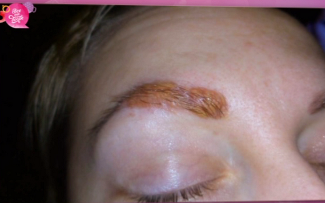 Небезпеки процедури мікроблейдинг: застереження від експертів наслідки мікроблейдінга