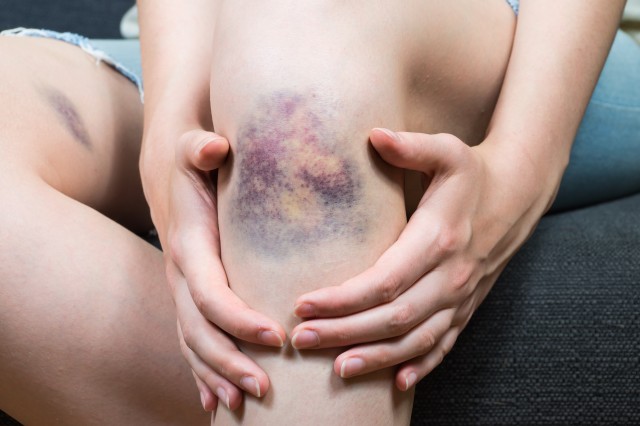 Bruise injury on young woman knee