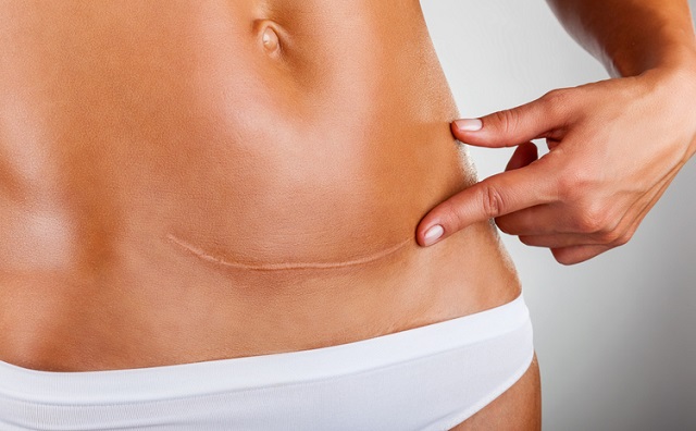 Кесарів розтин: що потрібно знати про операцію та наслідки Scar of caesarean section