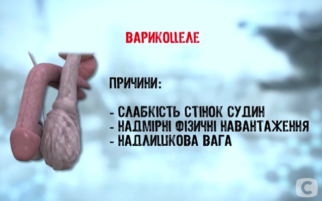 «Я соромлюсь свого тіла»-5: какие бывают заболевания мошонки? 2018-02-27_144223