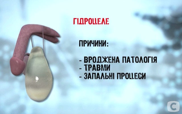 «Я соромлюсь свого тіла»-5: какие бывают заболевания мошонки? 2018-02-27_144938