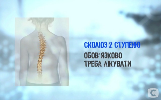 Что такое сколиоз и как его лечить 2018-04-02_131252