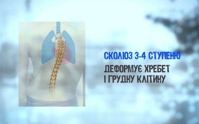 Что такое сколиоз и как его лечить 2018-04-02_131325