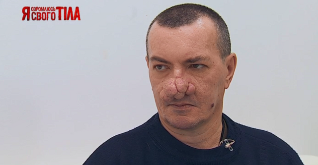 «Я соромлюсь свого тіла»: исправление шишковидного носа Виталия Груздева я соромлюсь свого тіла